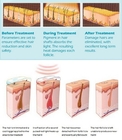 Non - invasive IPL RF Beauty Equipment / Permanent Hair Removal Machine