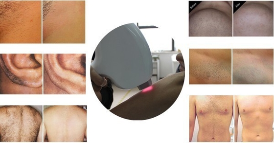 high qulity and commpetitive price 808nm diode laser hair removal machine