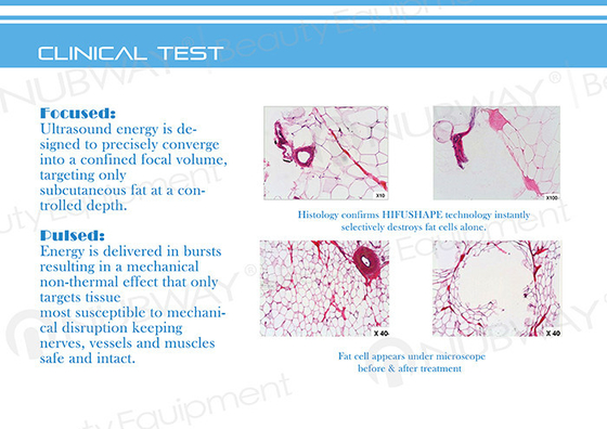 Fast cellulite reduction machine ultrasonic fat reduction hifu slimming treatments