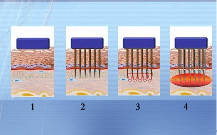 Fractional Laser Facial Machine